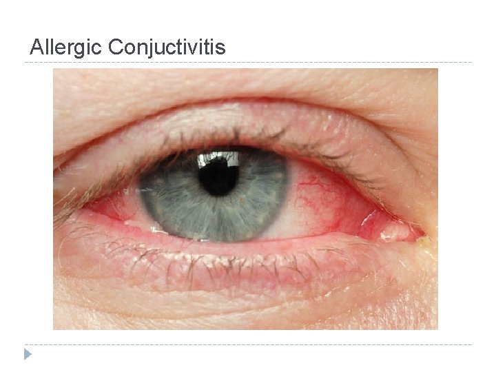 Allergic Conjuctivitis 