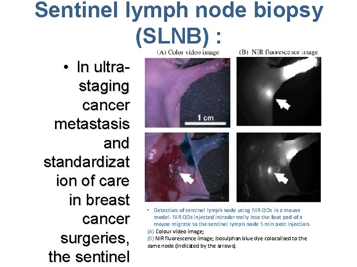 Sentinel lymph node biopsy (SLNB) : • In ultrastaging cancer metastasis and standardizat ion