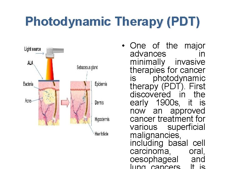 Photodynamic Therapy (PDT) • One of the major advances in minimally invasive therapies for