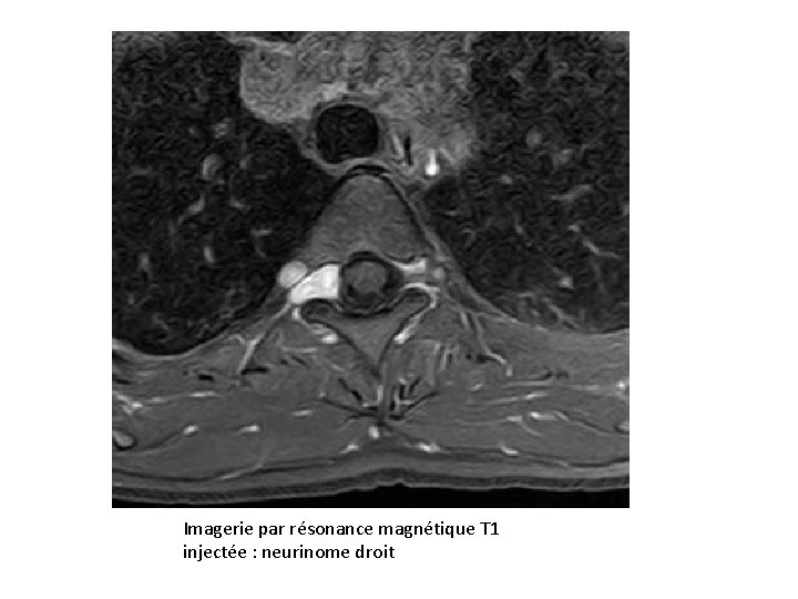 Imagerie par résonance magnétique T 1 injectée : neurinome droit 