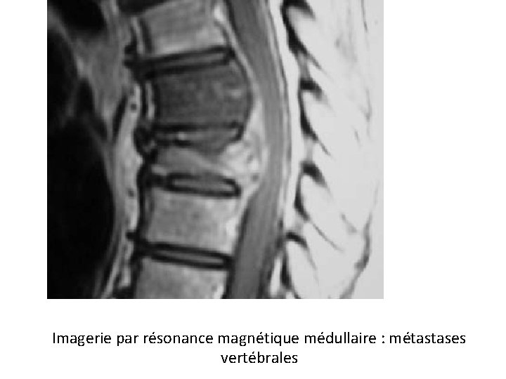 Imagerie par résonance magnétique médullaire : métastases vertébrales 