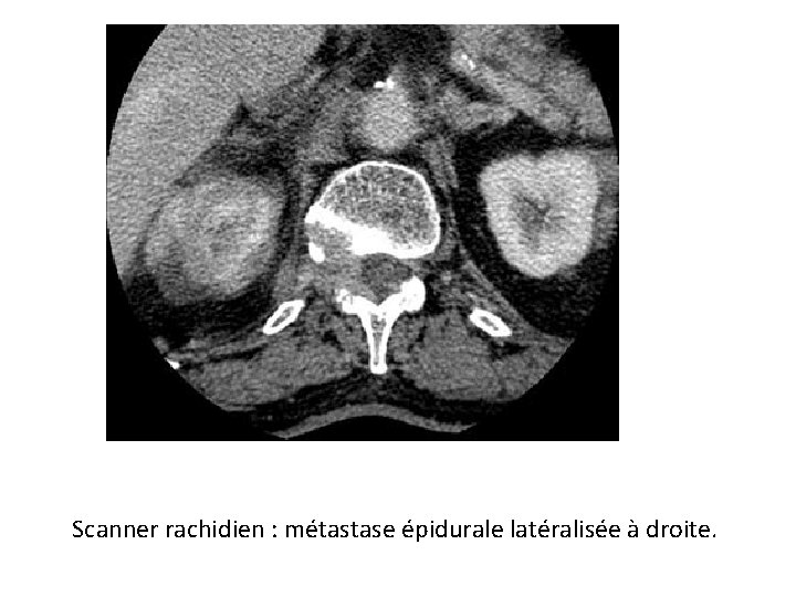 Scanner rachidien : métastase épidurale latéralisée à droite. 