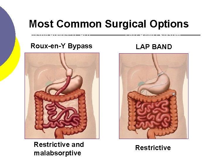 Most Common Surgical Options Gastric Bypass (GBP) Roux-en-Y Bypass Restrictive and malabsorptive LAP-BAND System