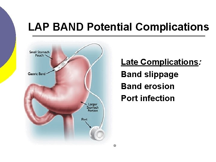 LAP BAND Potential Complications Late Complications: Band slippage Band erosion Port infection 