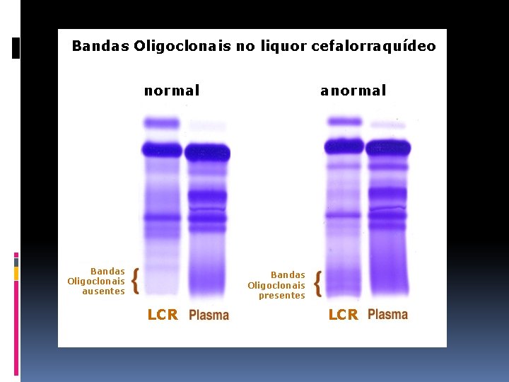 Bandas Oligoclonais no liquor cefalorraquídeo normal Bandas Oligoclonais ausentes anormal Bandas Oligoclonais presentes LCR