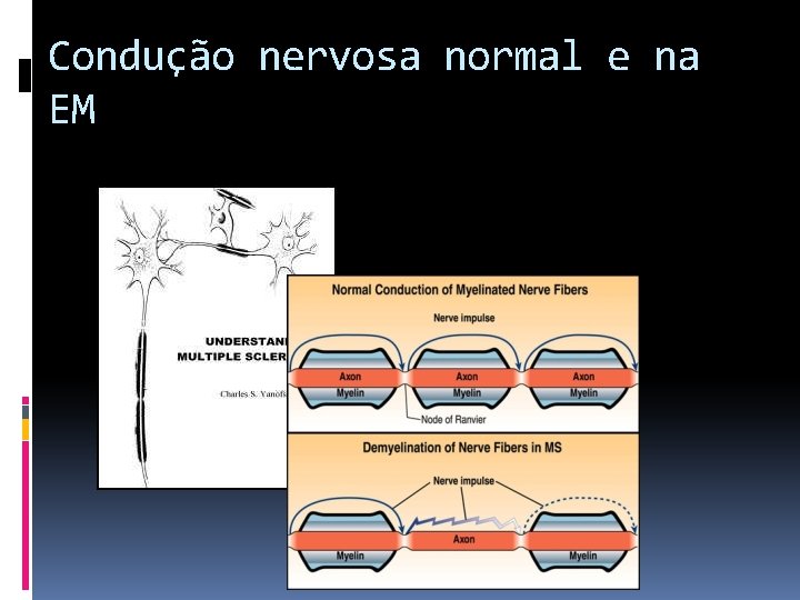 Condução nervosa normal e na EM 
