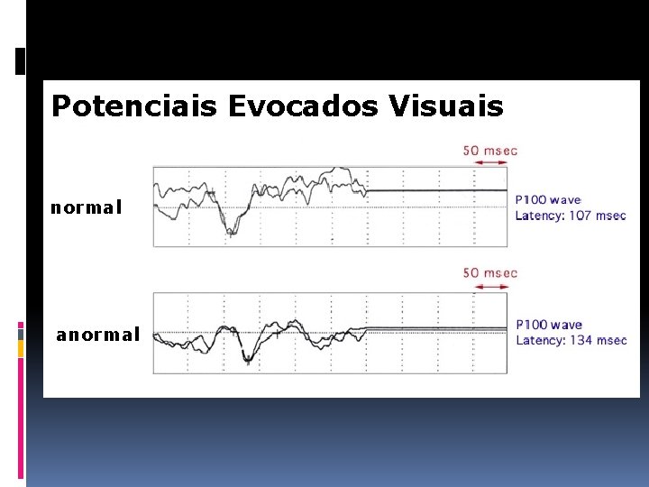 Potenciais Evocados Visuais normal anormal 