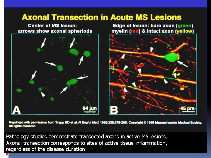 Pathology studies demonstrate transected axons in active MS lesions. Axonal transection corresponds to sites