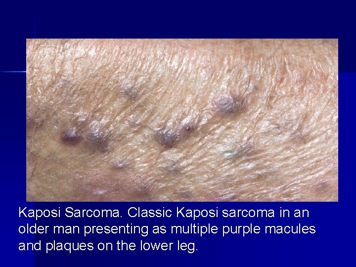 Kaposi Sarcoma. Classic Kaposi sarcoma in an older man presenting as multiple purple macules