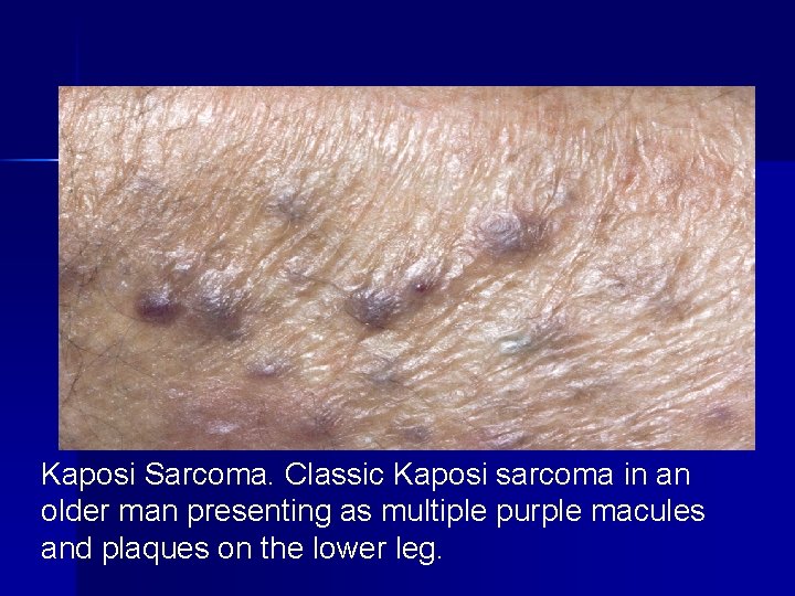 Kaposi Sarcoma. Classic Kaposi sarcoma in an older man presenting as multiple purple macules Kaposi Sarcoma. Classic Kaposi sarcoma in an older man presenting as multiple purple macules