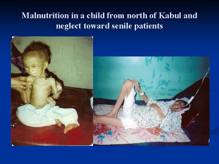 Malnutrition in a child from north of Kabul and neglect toward senile patients 