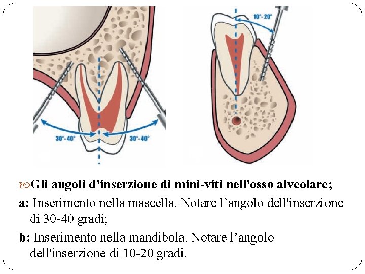  Gli angoli d'inserzione di mini-viti nell'osso alveolare; a: Inserimento nella mascella. Notare l’angolo