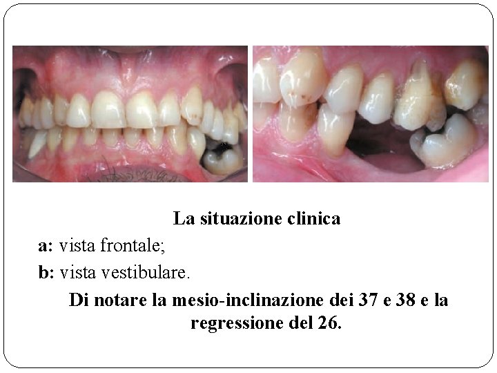 La situazione clinica a: vista frontale; b: vista vestibulare. Di notare la mesio-inclinazione dei