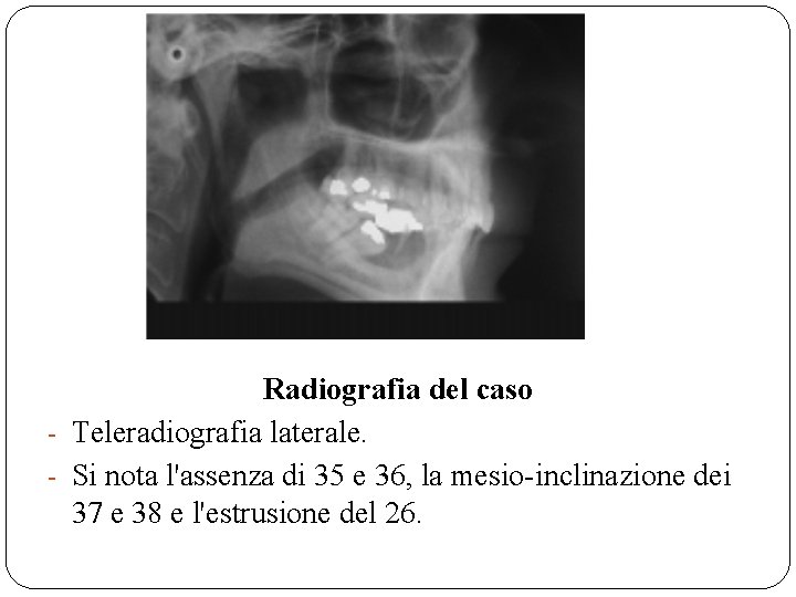 Radiografia del caso - Teleradiografia laterale. - Si nota l'assenza di 35 e 36,