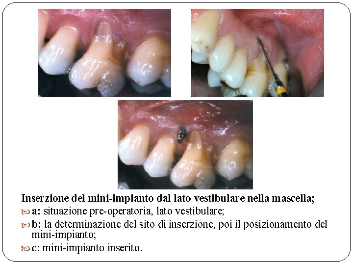 Inserzione del mini-impianto dal lato vestibulare nella mascella; a: situazione pre-operatoria, lato vestibulare; b: