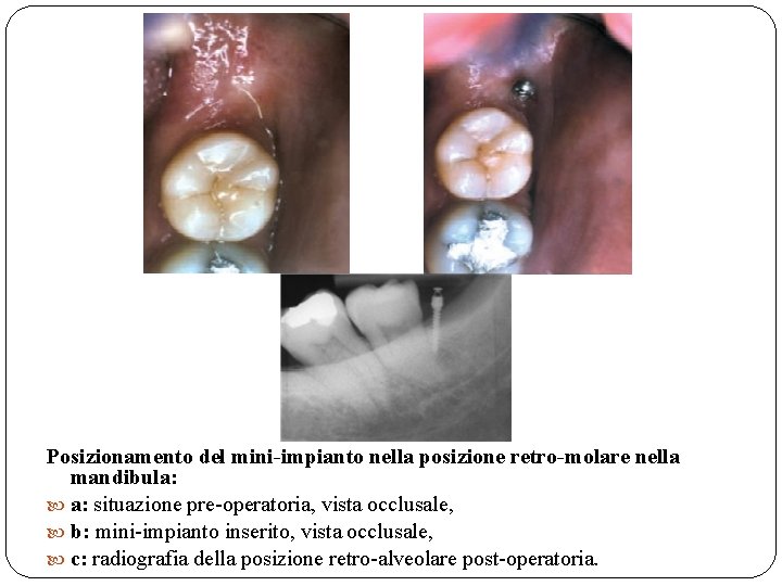 Posizionamento del mini-impianto nella posizione retro-molare nella mandibula: a: situazione pre-operatoria, vista occlusale, b:
