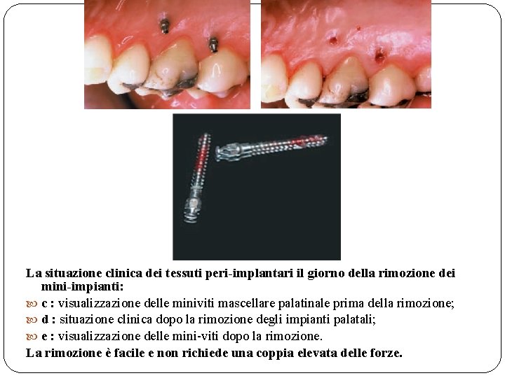 La situazione clinica dei tessuti peri-implantari il giorno della rimozione dei mini-impianti: c :