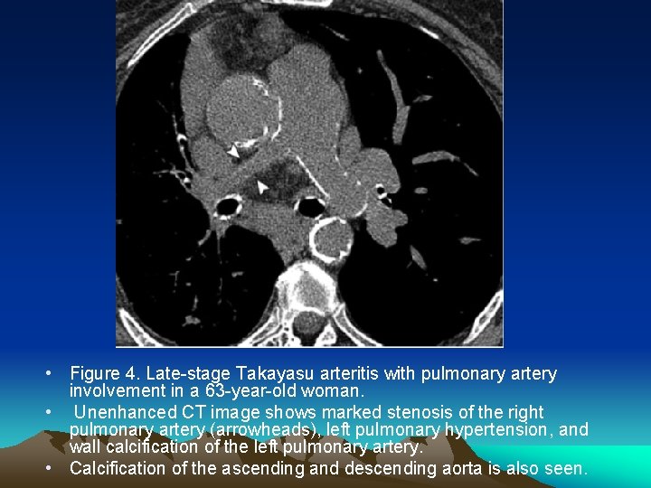  • Figure 4. Late-stage Takayasu arteritis with pulmonary artery involvement in a 63