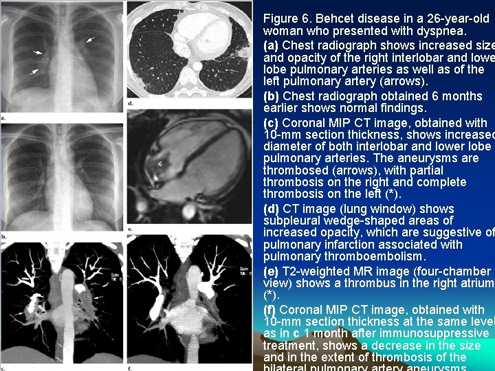  • • Figure 6. Behcet disease in a 26 -year-old woman who presented