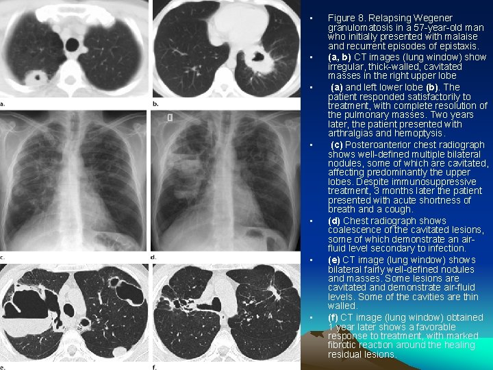  • • Figure 8. Relapsing Wegener granulomatosis in a 57 -year-old man who