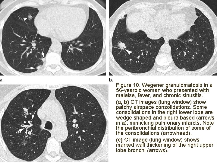  • • • Figure 10. Wegener granulomatosis in a 56 -yearold woman who