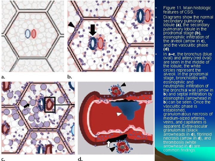  • • • Figure 11. Main histologic features of CSS. Diagrams show the