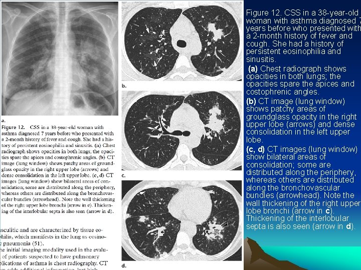  • • Figure 12. CSS in a 38 -year-old woman with asthma diagnosed