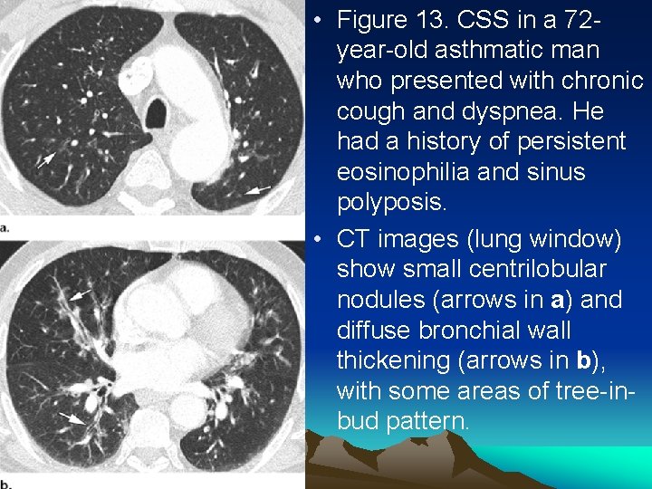  • Figure 13. CSS in a 72 year-old asthmatic man who presented with