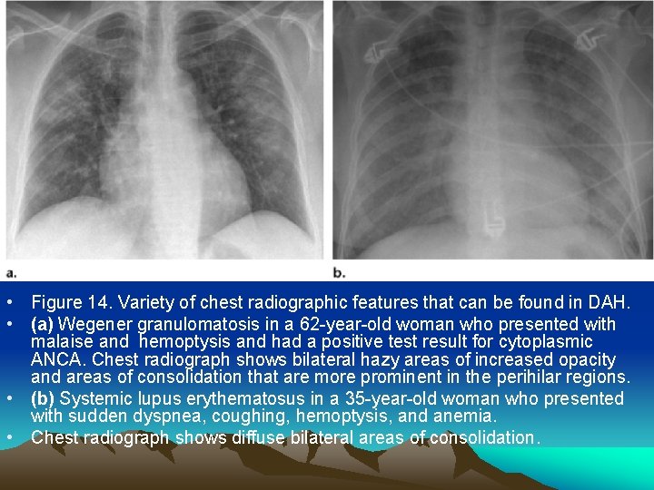  • Figure 14. Variety of chest radiographic features that can be found in