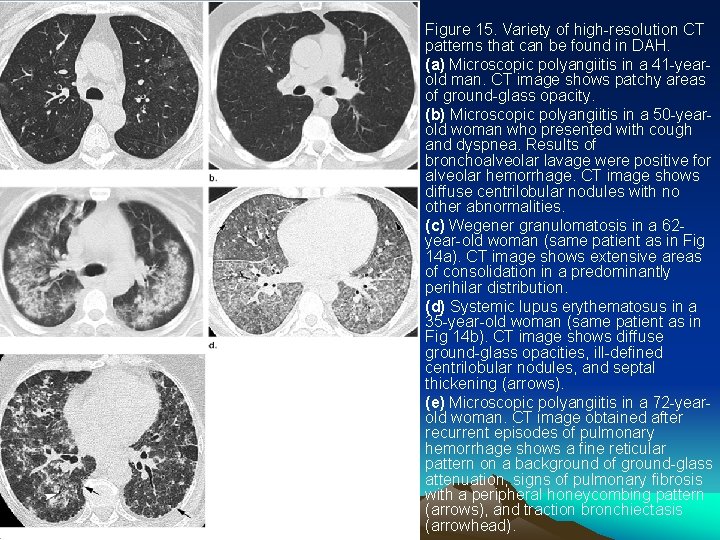  • • • Figure 15. Variety of high-resolution CT patterns that can be