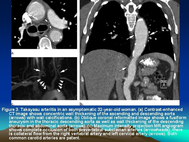 Figure 3. Takayasu arteritis in an asymptomatic 32 -year-old woman. (a) Contrast-enhanced CT image