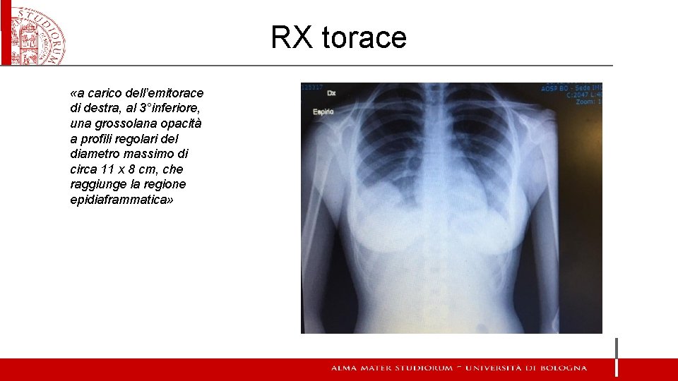 RX torace «a carico dell’emitorace di destra, al 3°inferiore, una grossolana opacità a profili