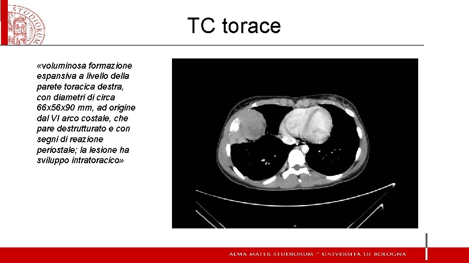 TC torace «voluminosa formazione espansiva a livello della parete toracica destra, con diametri di