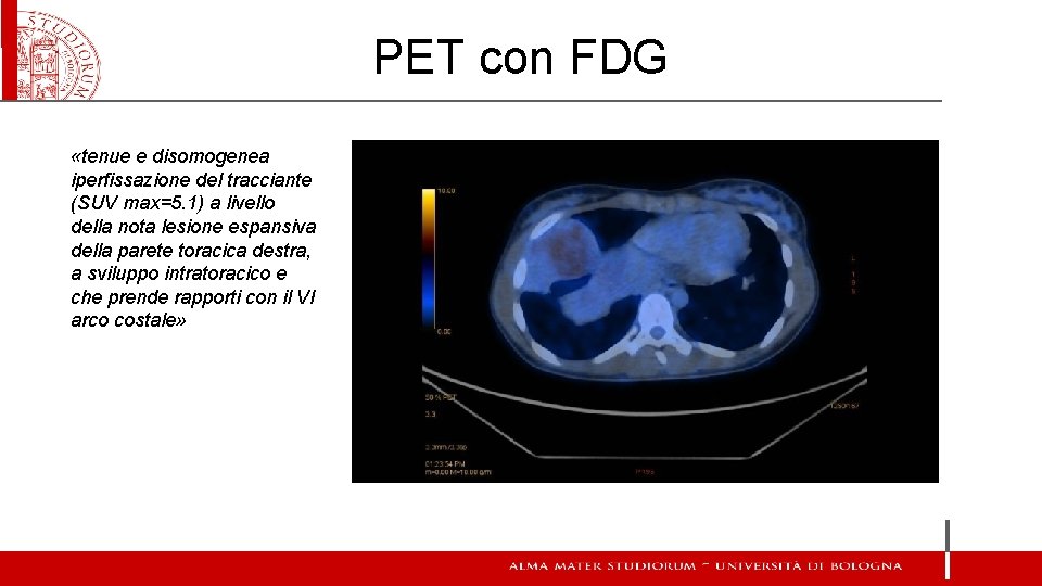 PET con FDG «tenue e disomogenea iperfissazione del tracciante (SUV max=5. 1) a livello