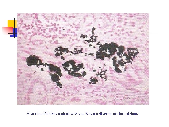 A section of kidney stained with von Kossa’s silver nirate for calcium. 