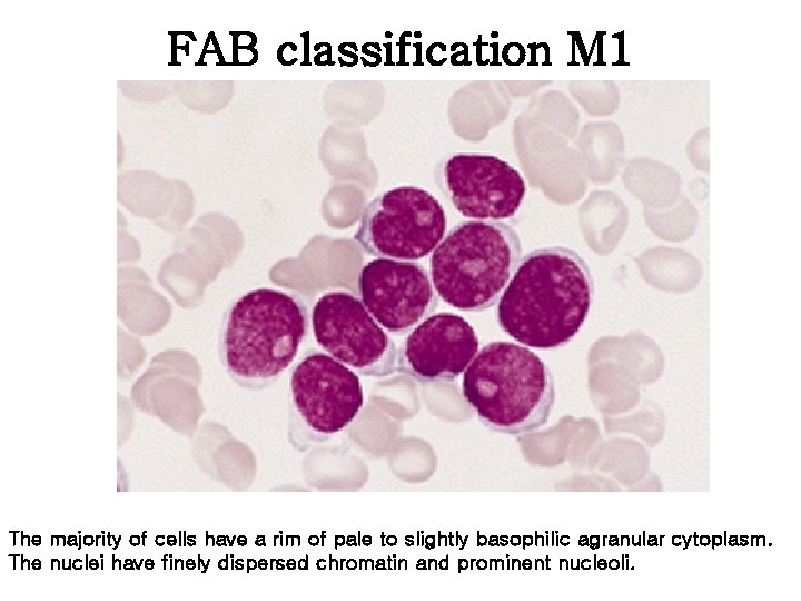 FAB classification M 1 The majority of cells have a rim of pale to