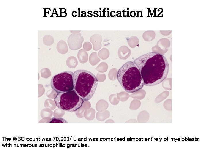 FAB classification M 2 The WBC count was 70, 000/ L and was comprised