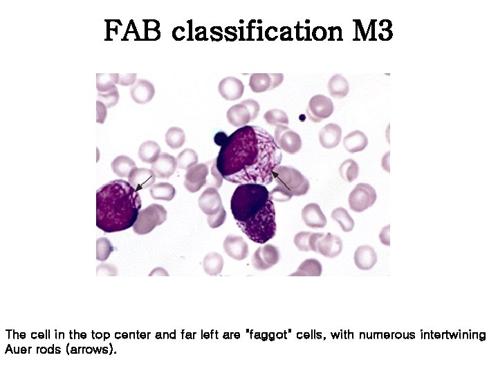 FAB classification M 3 The cell in the top center and far left are