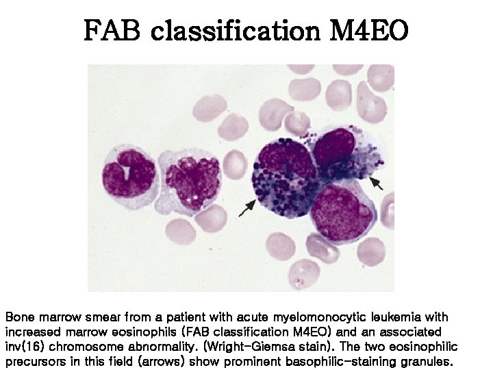 FAB classification M 4 EO Bone marrow smear from a patient with acute myelomonocytic