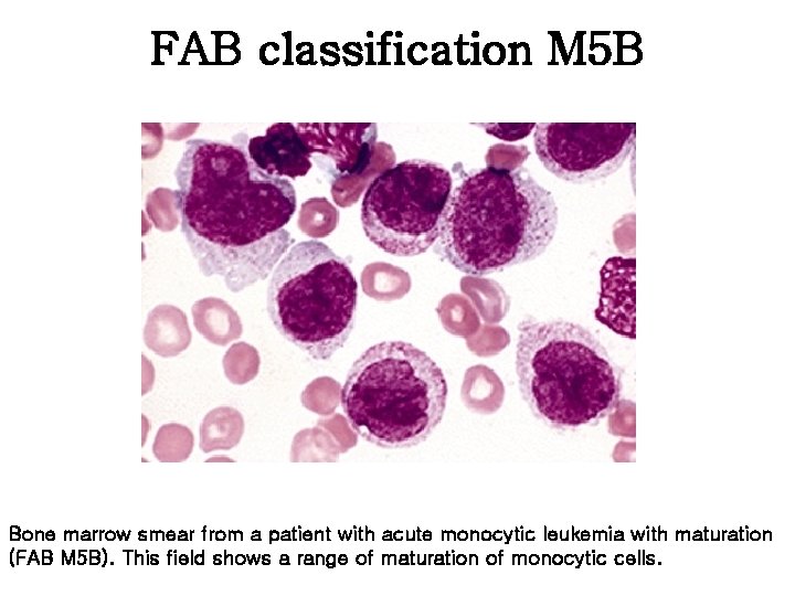 FAB classification M 5 B Bone marrow smear from a patient with acute monocytic