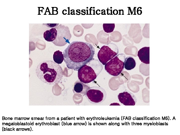 FAB classification M 6 Bone marrow smear from a patient with erythroleukemia (FAB classification
