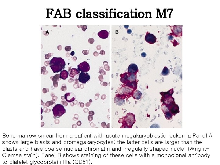 FAB classification M 7 Bone marrow smear from a patient with acute megakaryoblastic leukemia