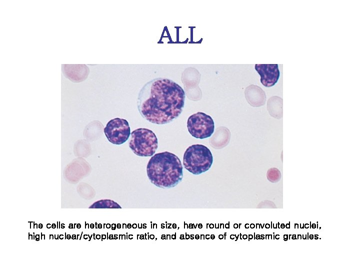 ALL The cells are heterogeneous in size, have round or convoluted nuclei, high nuclear/cytoplasmic