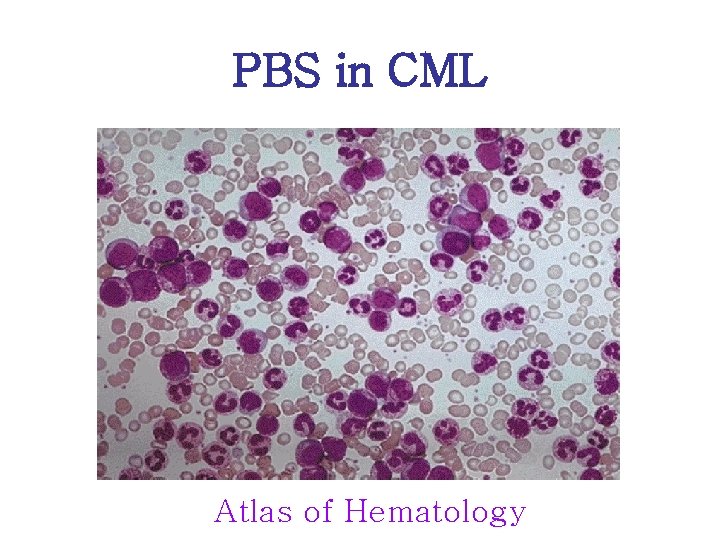 PBS in CML Atlas of Hematology 