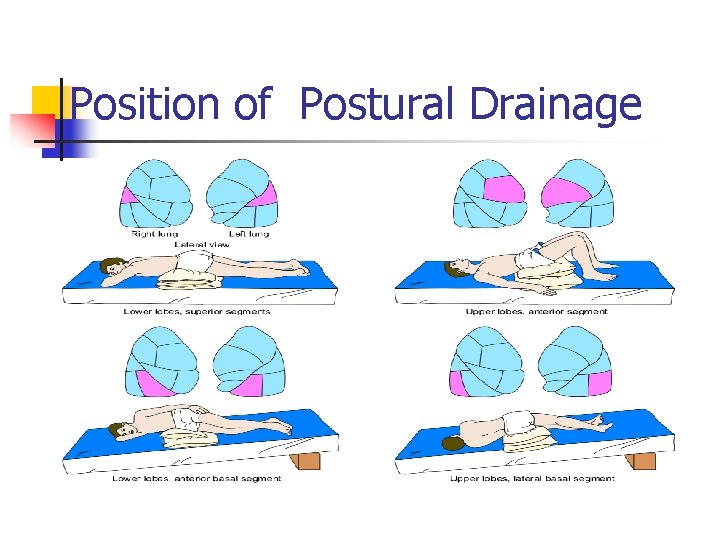 Position of Postural Drainage 