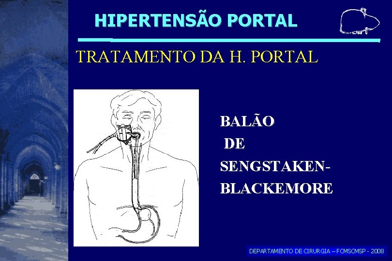 HIPERTENSÃO PORTAL TRATAMENTO DA H. PORTAL BALÃO DE SENGSTAKENBLACKEMORE DEPARTAMENTO DE CIRURGIA – FCMSCMSP HIPERTENSÃO PORTAL TRATAMENTO DA H. PORTAL BALÃO DE SENGSTAKENBLACKEMORE DEPARTAMENTO DE CIRURGIA – FCMSCMSP