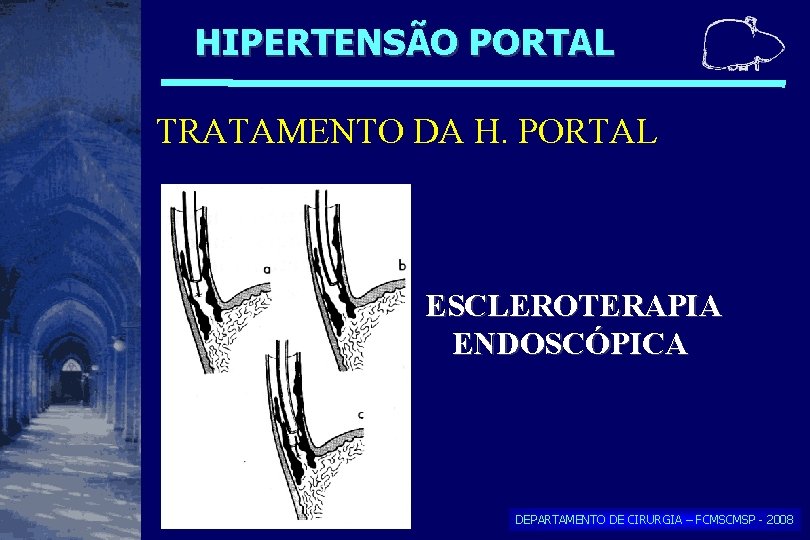HIPERTENSÃO PORTAL TRATAMENTO DA H. PORTAL ESCLEROTERAPIA ENDOSCÓPICA DEPARTAMENTO DE CIRURGIA – FCMSCMSP - HIPERTENSÃO PORTAL TRATAMENTO DA H. PORTAL ESCLEROTERAPIA ENDOSCÓPICA DEPARTAMENTO DE CIRURGIA – FCMSCMSP -