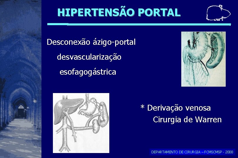 HIPERTENSÃO PORTAL Desconexão ázigo-portal desvascularização esofagogástrica * Derivação venosa Cirurgia de Warren DEPARTAMENTO DE HIPERTENSÃO PORTAL Desconexão ázigo-portal desvascularização esofagogástrica * Derivação venosa Cirurgia de Warren DEPARTAMENTO DE
