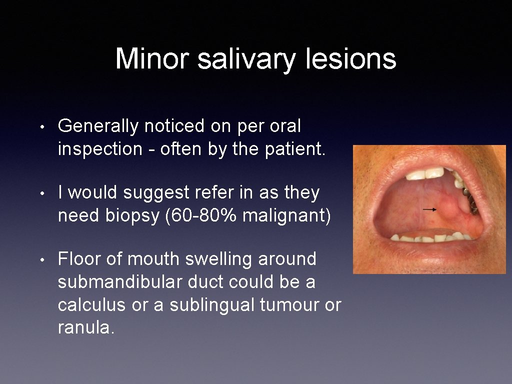 Minor salivary lesions • Generally noticed on per oral inspection - often by the