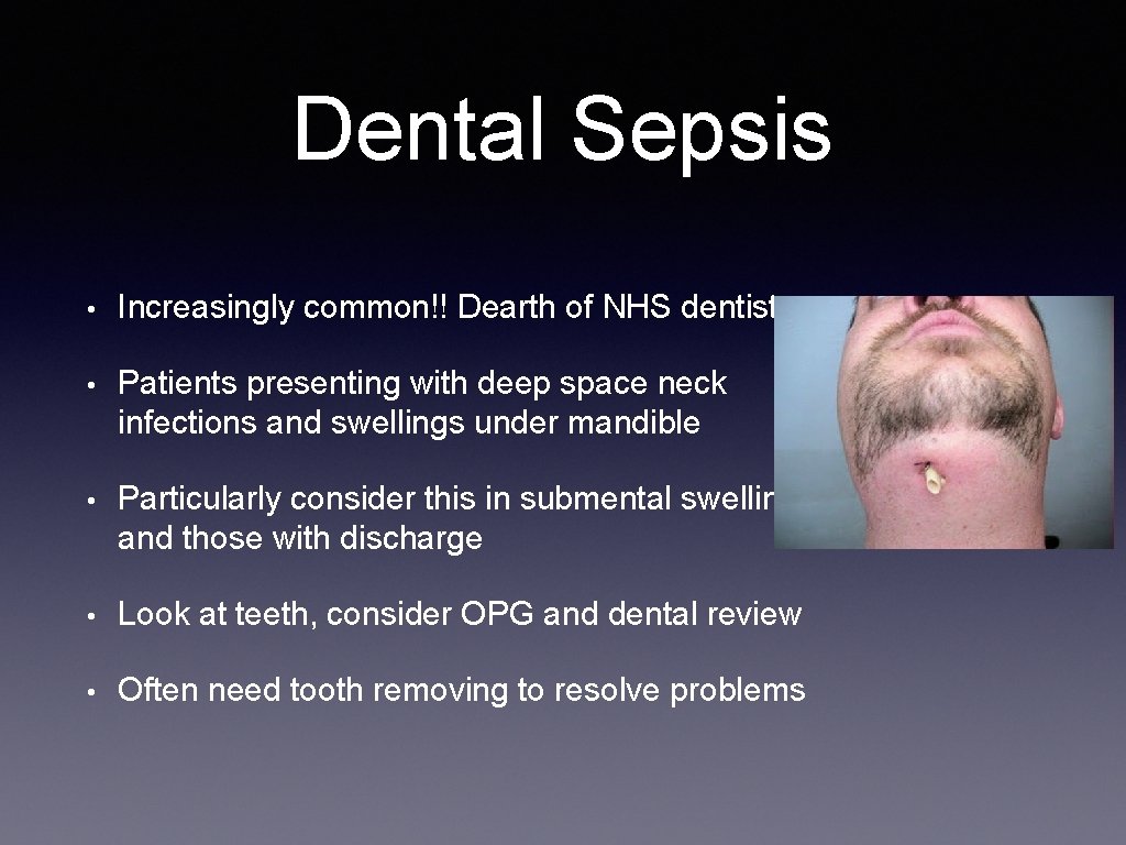 Dental Sepsis • Increasingly common!! Dearth of NHS dentistry • Patients presenting with deep